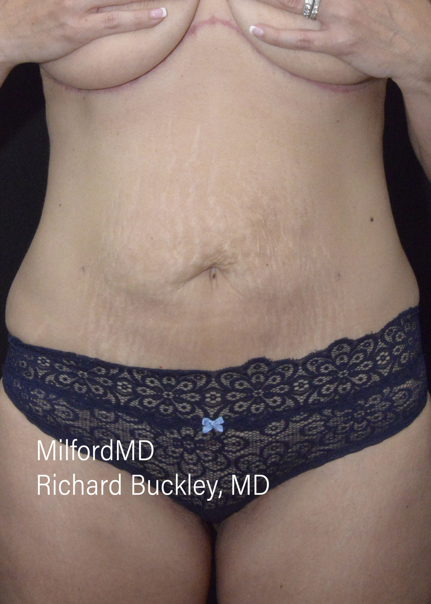 Reverse Abdominoplasty Before and After Photos,Reverse Abdominoplasty,Reverse Abdominoplasty Before and After, Abdominoplasty – Reverse