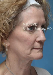 collagen filler by MilfordMD