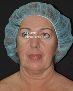 Skin Tightening Of Jowls front before photo - MilfordMD Cosmetic Dermatology Surgery