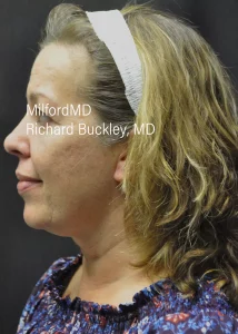 Skin Tightening Of Jowls Left After photo - MilfordMD Cosmetic Dermatology Surgery