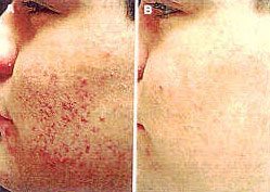 BEFORE AND AFTER MICRODERMABRASION PARISIAN PEEL at MilfordMD