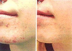 BEFORE AND AFTER MICRODERMABRASION PARISIAN PEEL by MilfordMD Marina Buckley, MD