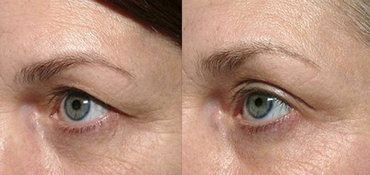 Eyelid Lift at MilfordMD