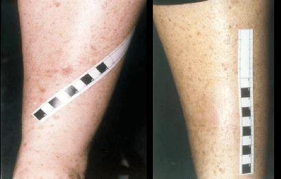 OMNILUX & SKIN CANCER By MilfordMD