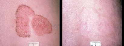 OMNILUX & SKIN CANCER By MilfordMD