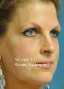 dysport-procedures-After by MilfordMD in Richard Buckley, MD