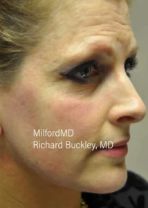 dysport-procedures-Before by MilfordMD in Richard Buckley, MD