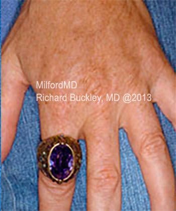Hand Rejuvenation Procedures Before & After Photos,Hand Rejuvenation Procedures near me,MilfordMD Cosmetic Dermatology, Hand Rejuvenation Procedures