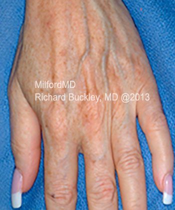 Before: Fat Transfer Hands – Case #35922