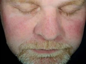hydrafacial-sun-damage-featured-new-after