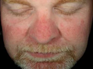 hydrafacial-sun-damage-featured-new-before