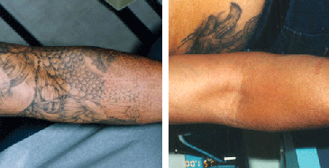 TATTOO REMOVAL by MilfordMD Marina Buckley, MD