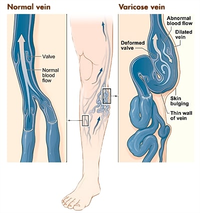 Varicose Veins By MilfordMD