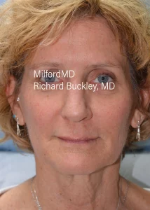 dermal fillers by MilfordMD