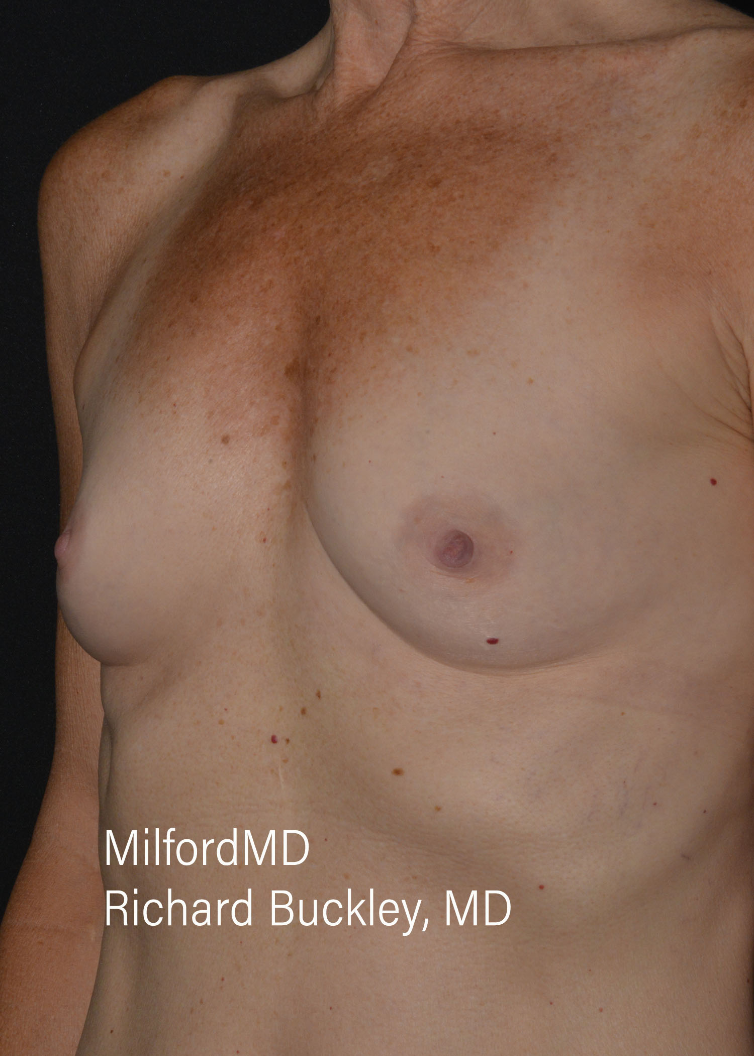 Before: BREAST AUGMENTATION – CASE #35675