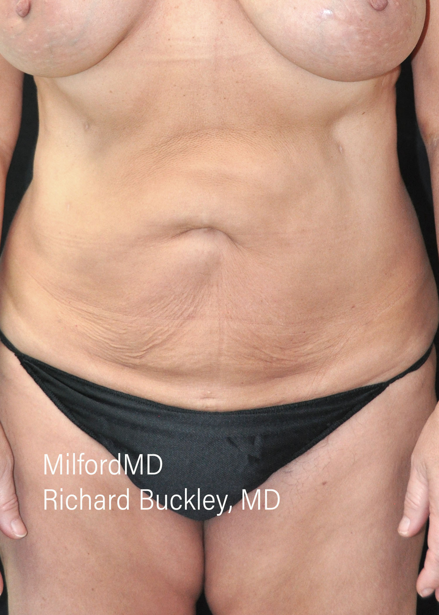 After: ABDOMINOPLASTY CASE #62005