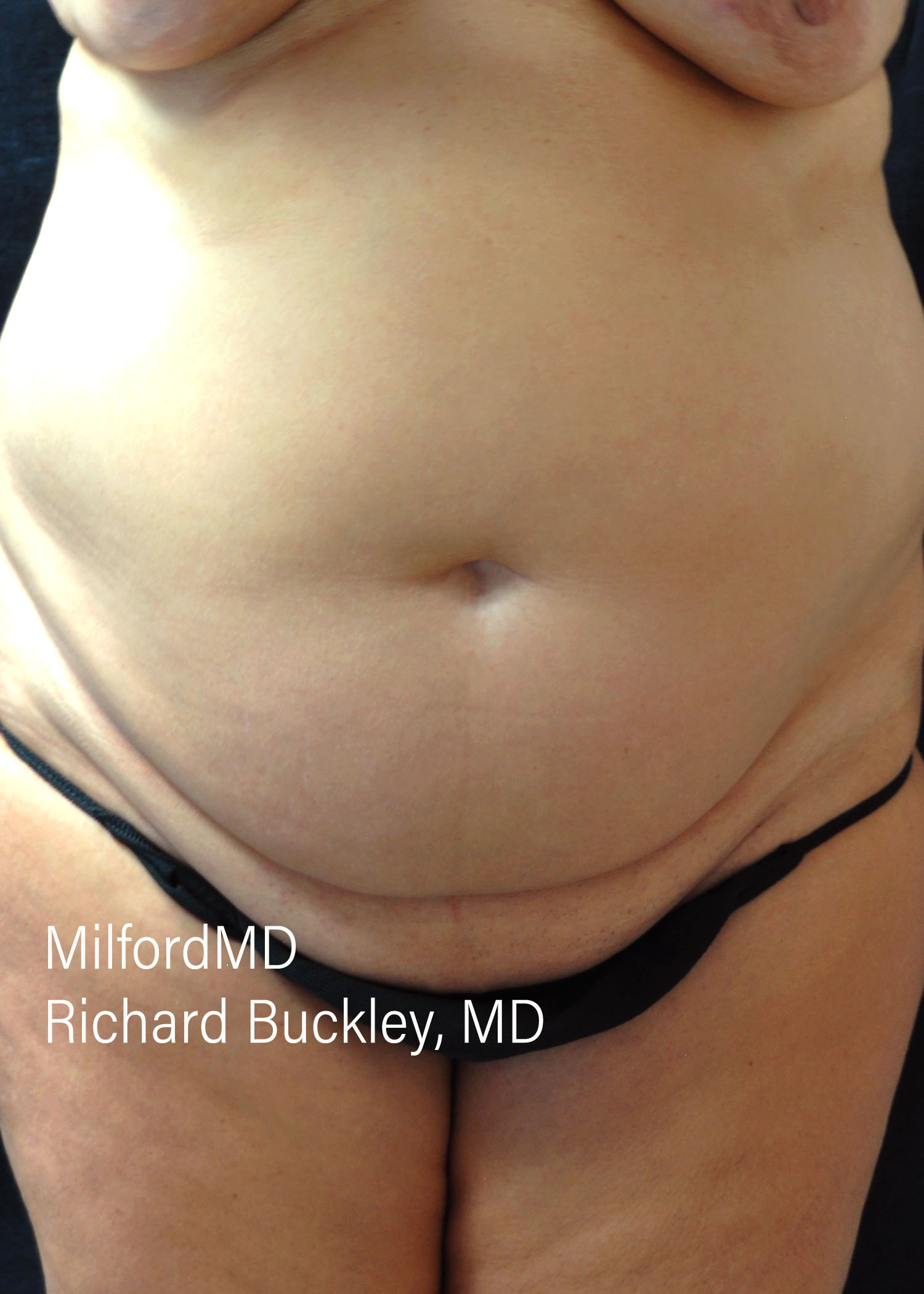 Before: ABDOMINOPLASTY CASE #62005