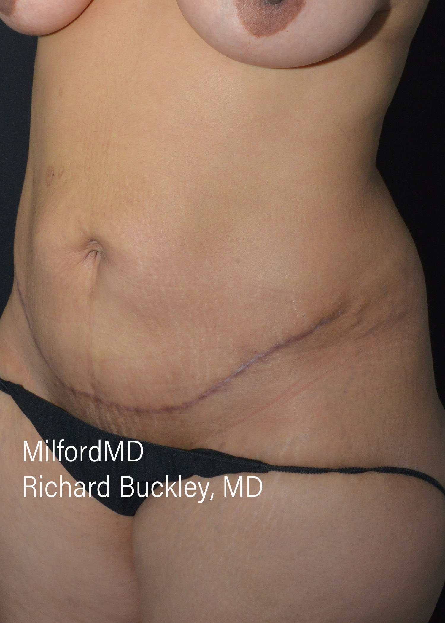 After: ABDOMINOPLASTY CASE #62004