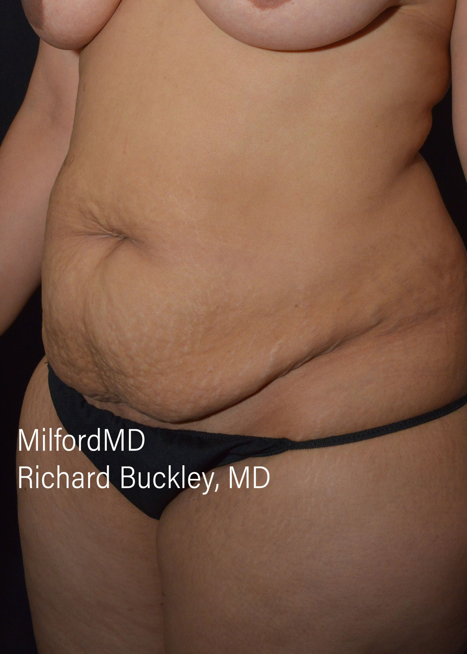 Before: ABDOMINOPLASTY CASE #62004