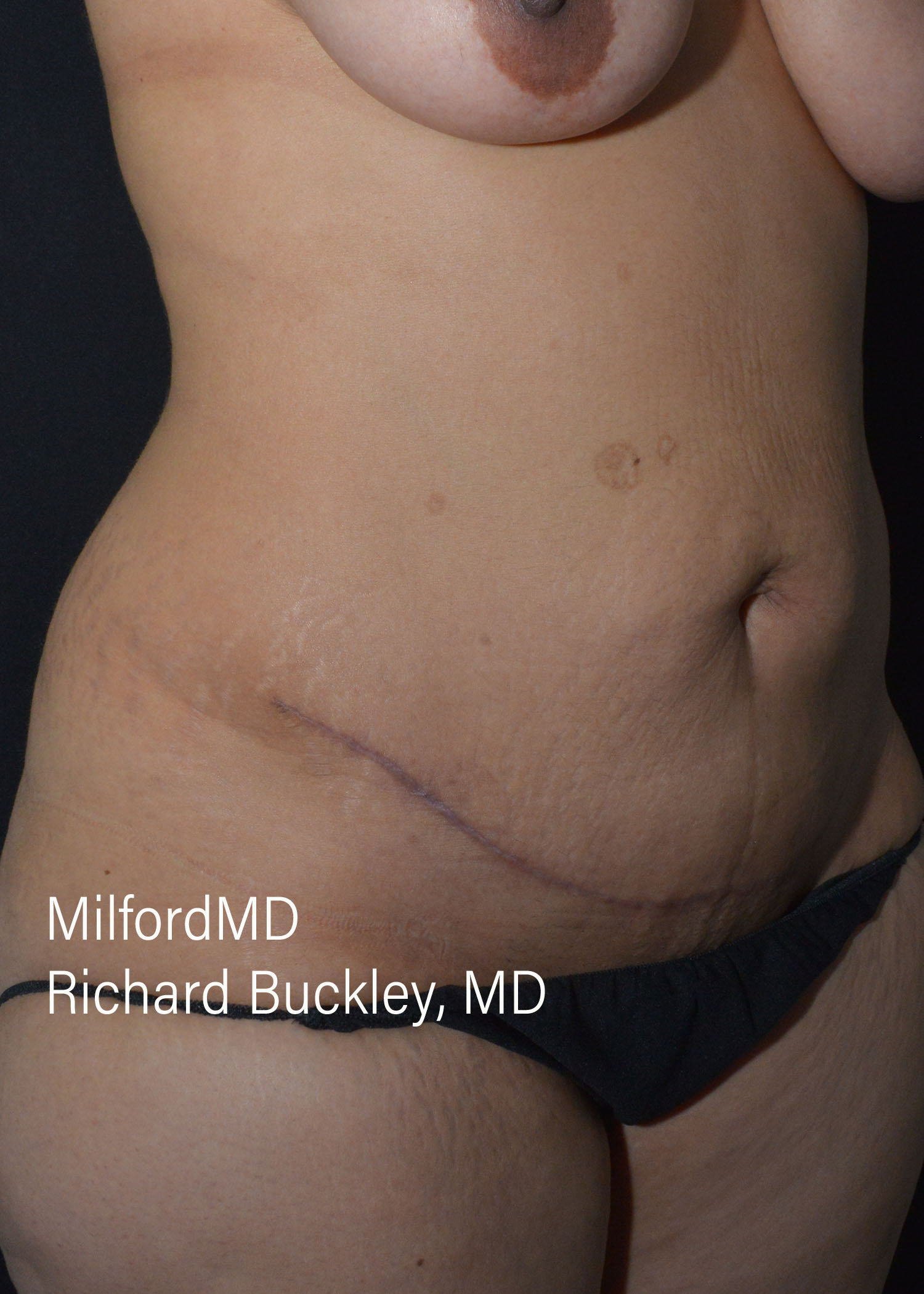 After: ABDOMINOPLASTY CASE #62004