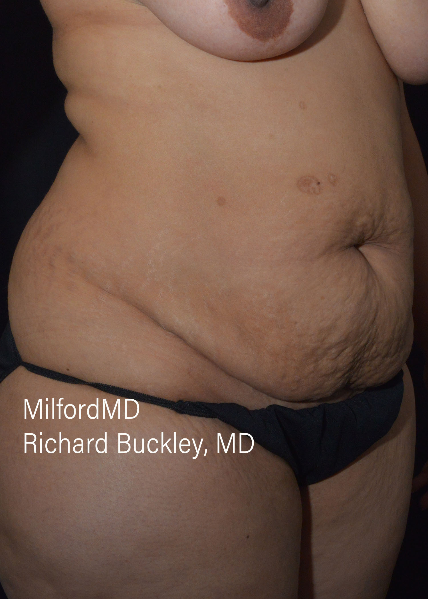 Before: ABDOMINOPLASTY CASE #62004