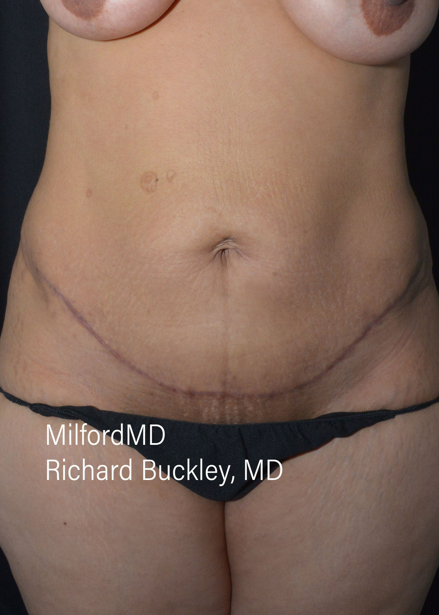 After: ABDOMINOPLASTY CASE #62004