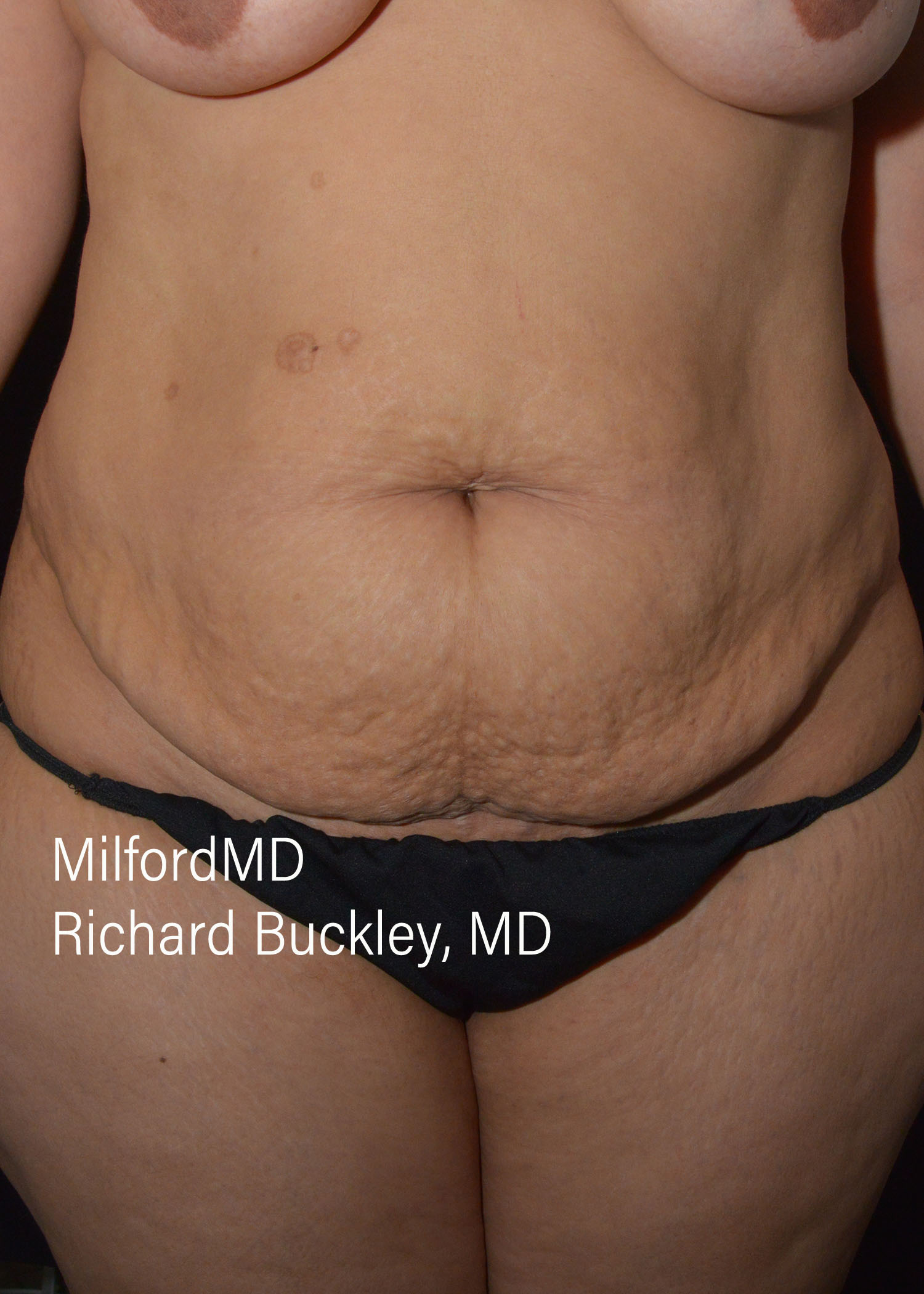 Before: ABDOMINOPLASTY CASE #62004