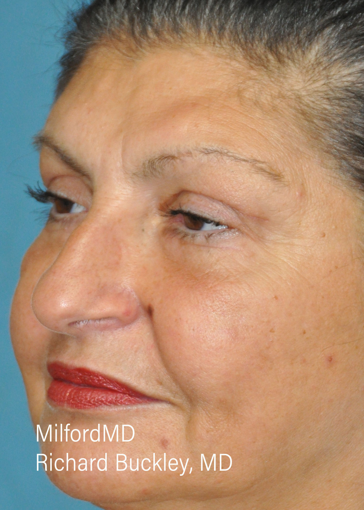 After: BLEPHAROPLASTY – CASE #36112