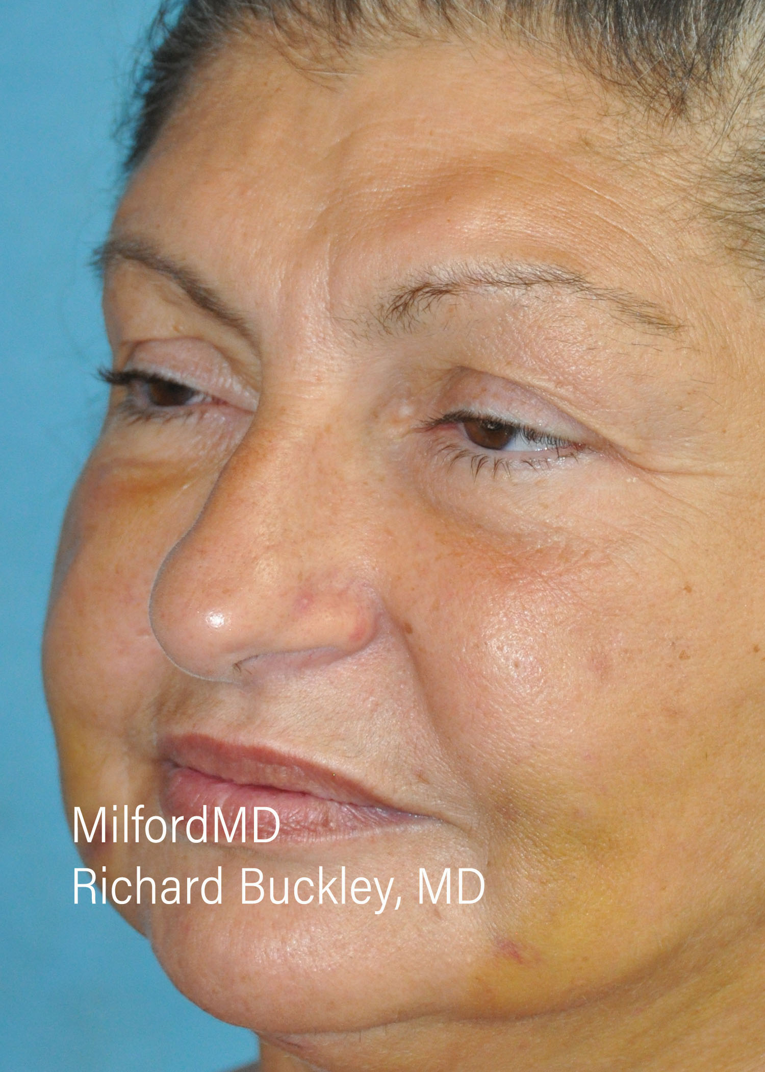 Before: BLEPHAROPLASTY – CASE #36112