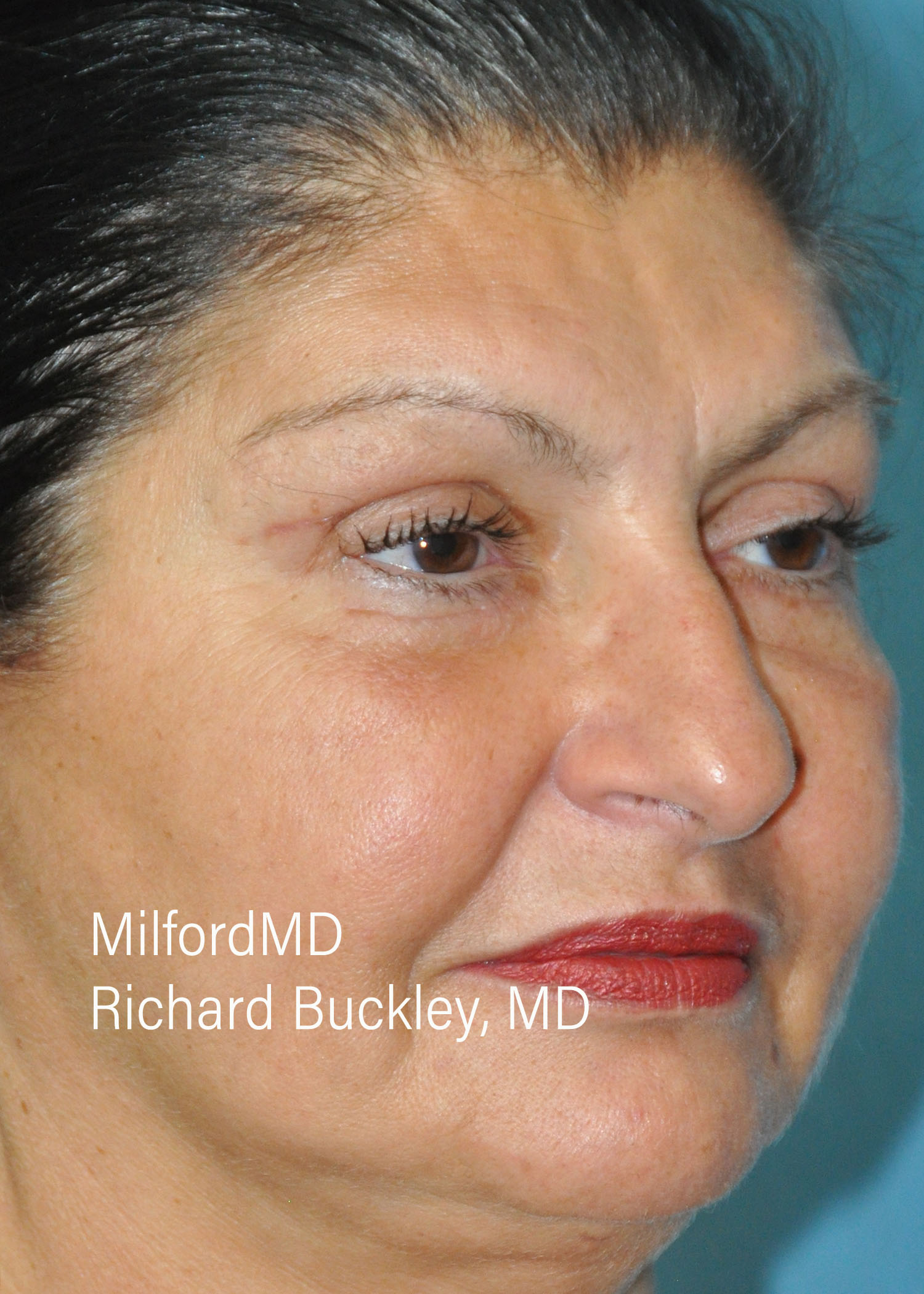 After: BLEPHAROPLASTY – CASE #36112