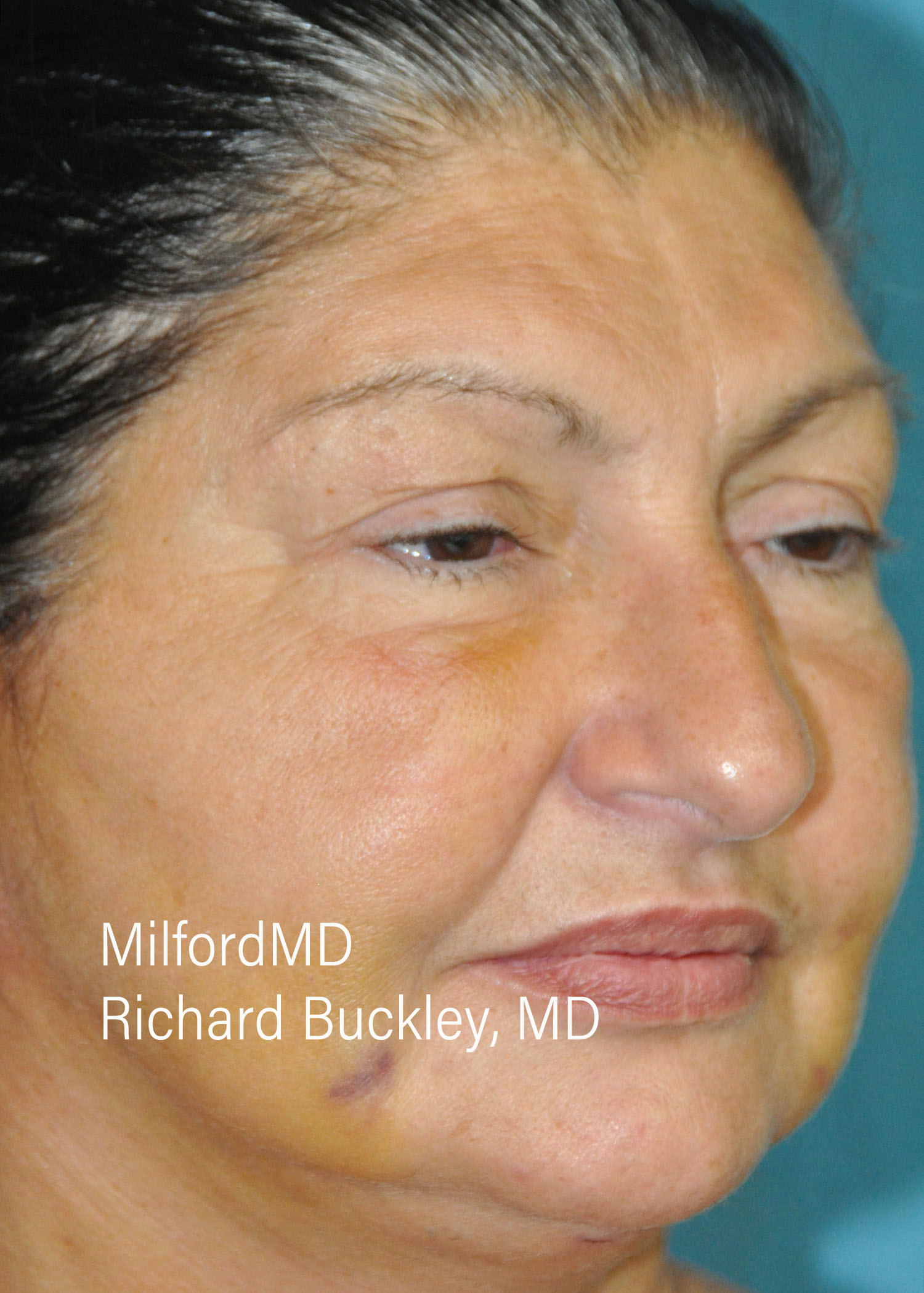 Before: BLEPHAROPLASTY – CASE #36112