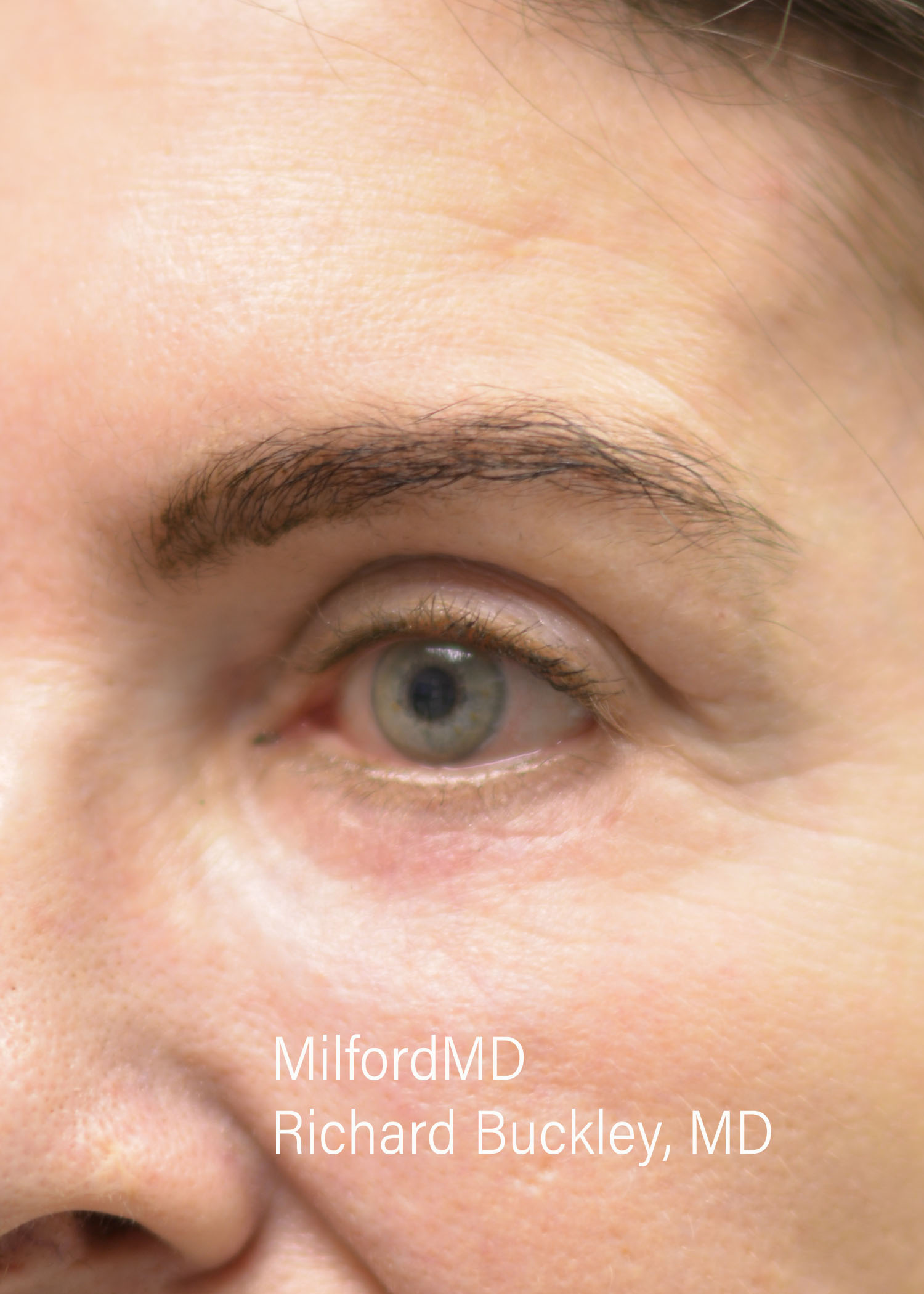 After: Blepharoplasty – CASE #32114