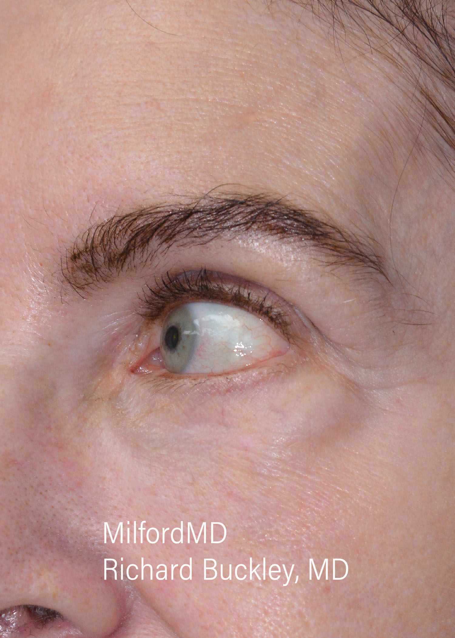 Before: Blepharoplasty – CASE #32114