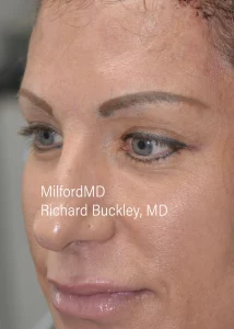 Brow-Lift-Two-L-After-by MilfordMD in Richard Buckley, MD