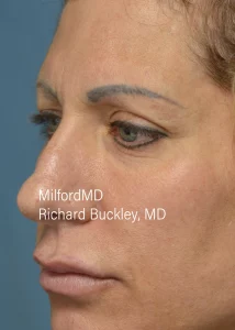 Brow-Lift-Two-L-Before-by MilfordMD in Richard Buckley, MD