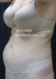 coolSculpting–body-45L-before-4-by MilfordMD in Richard Buckley, MD