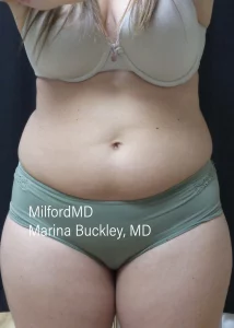 coolSculpting body 3 Front Before by MilfordMD Marina Buckley, MD