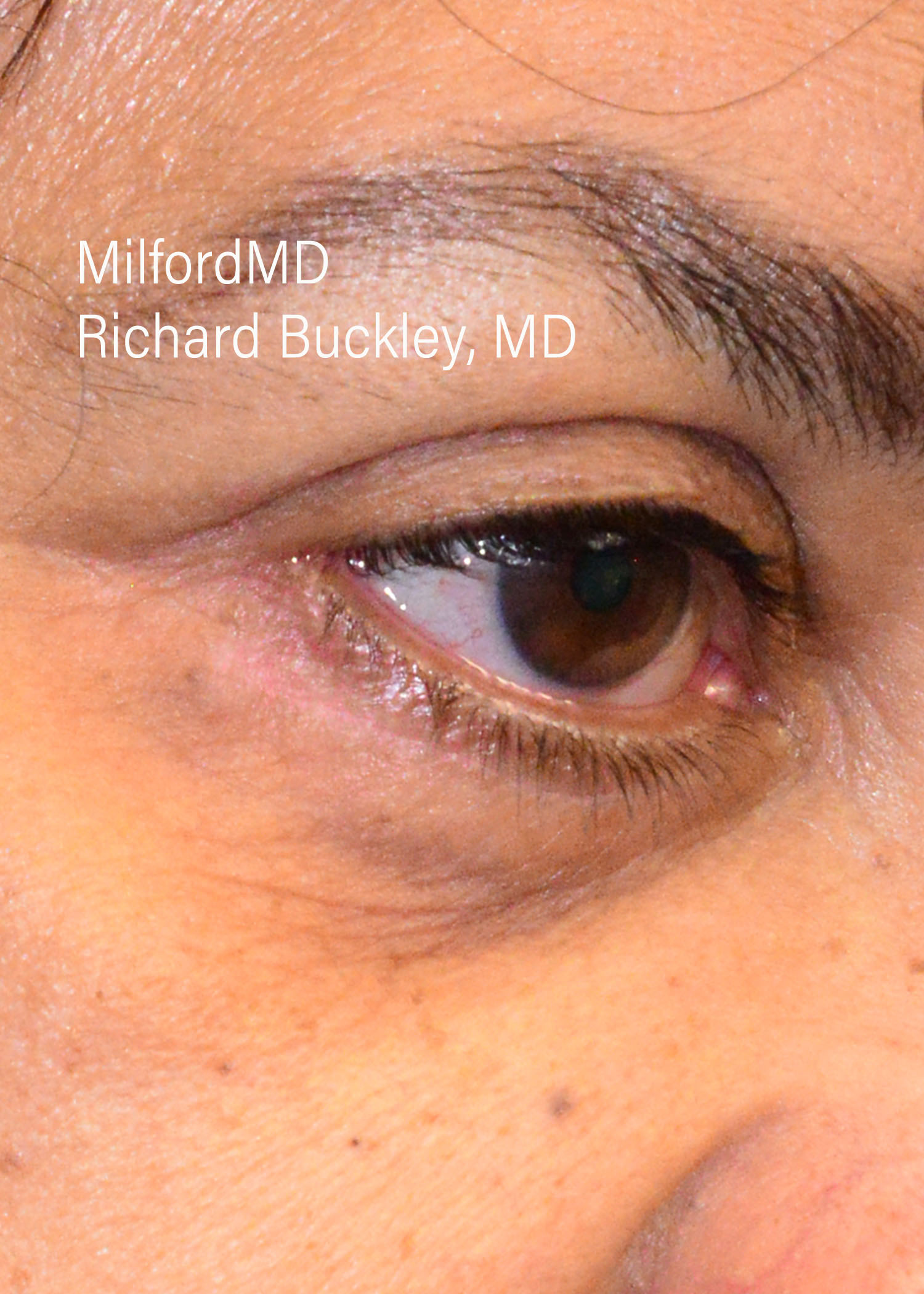 Lower Blepharoplasty Before and After Photos,Lower Blepharoplasty Before & After Photos,Lower Blepharoplasty Before and After Gallery,Lower Eyelid Surgery Before & After Photos,Lower Blepharoplasty Before & After, Cosmetic Removals