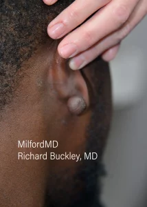 Cosmetic Removals Before Milford PA by MilfordMD