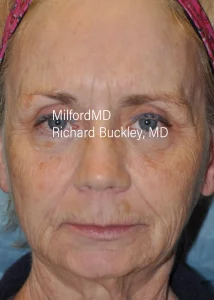 Face AFT Front After Photo