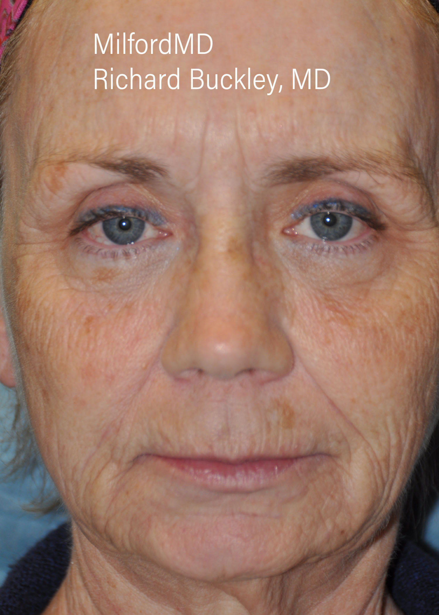 After: Fat Transfer to Face (AFT)- Case #36110