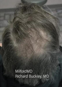 Hair Restoration One After Min Milford PA by MilfordMD