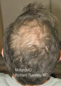 Hair Restoration One Before Min Milford PA by MilfordMD