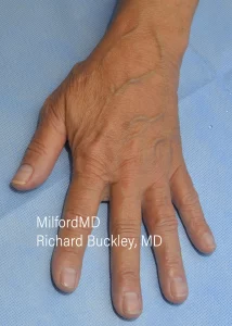 Hand rejuvenation L After Photo by Milford MD