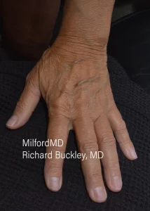 Hand rejuvenation L Before Photo by Milford MD