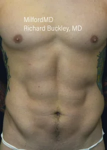 Liposuction Male case2 Front After by MilfordMD
