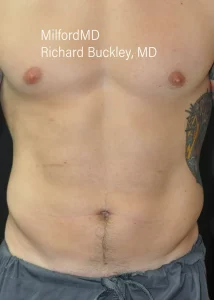 Liposuction Male case2 Front Before by MilfordMD