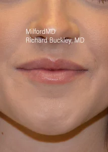 lip injections by MilfordMD