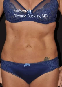 laser-liposuction After Front by MilfordMD in Richard Buckley, MD