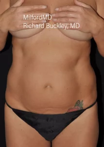 laser-liposuction a1 Before Front by MilfordMD in Richard Buckley, MD